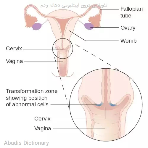 نئوپلازی درون اپیتلیومی دهانه رحم